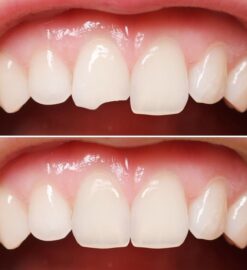 Dental Bonding for Sensitive Teeth: A Gentle Solution in Jackson Heights