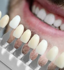 Are You a Candidate for Veneers? Here’s How to Find Out