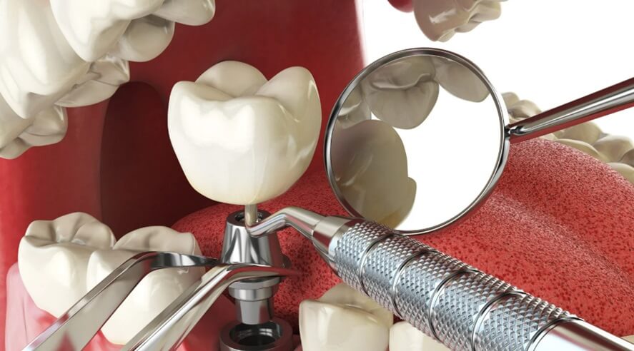 Dental Implants